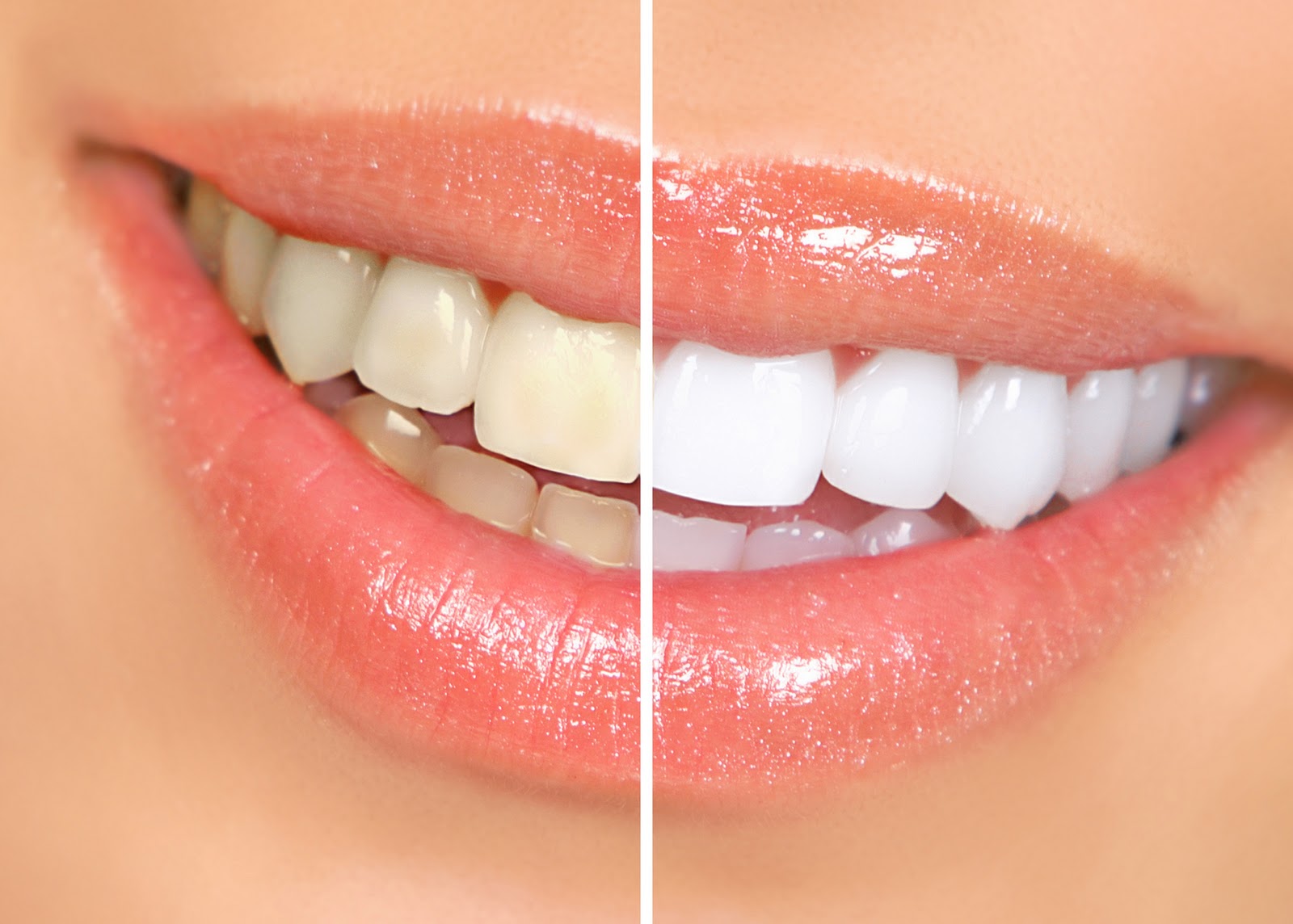 Teeth whitening bleaching 1